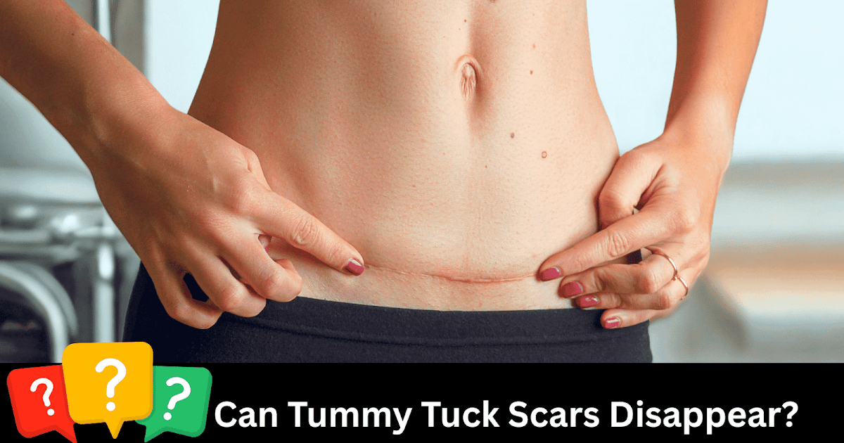 Do Tummy Tuck Scars Disappear—Or Can They Change into a Masterpiece?