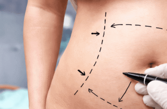 How Does Liposculpture Work? A Step-by-Step Take a look at the Process