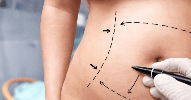 How Does Liposculpture Work? A Step-by-Step Take a look at the Process
